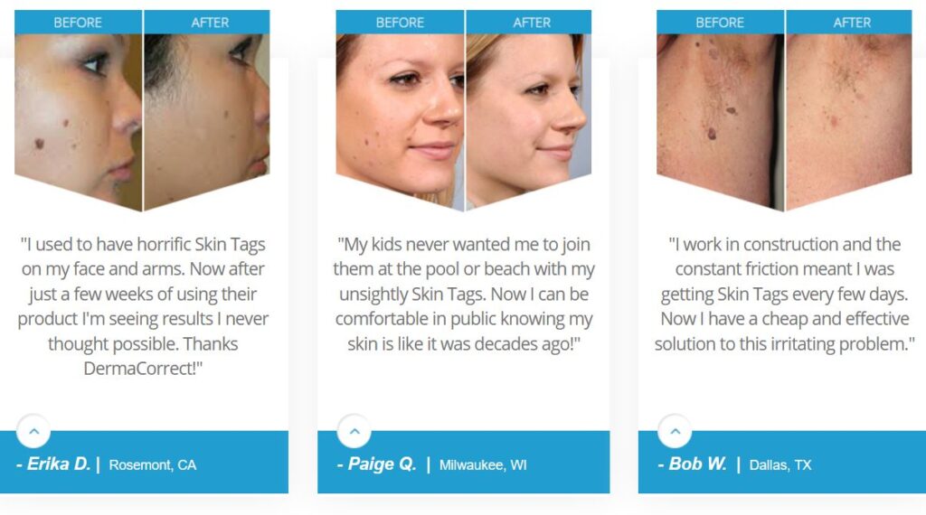 what is skin tag remover